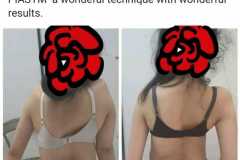 Scoliosis Management with KIASTM/PIASTM Protocol