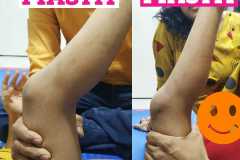 Hamstring Release  With PIASTM protocol