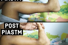 Calf Muscle Release with PIASTM protocol