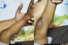 Hamstring Release  With PIASTM protocol