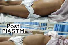 Abdominal and Diaphragm Protocol to Improve  Diaphragm Breathing