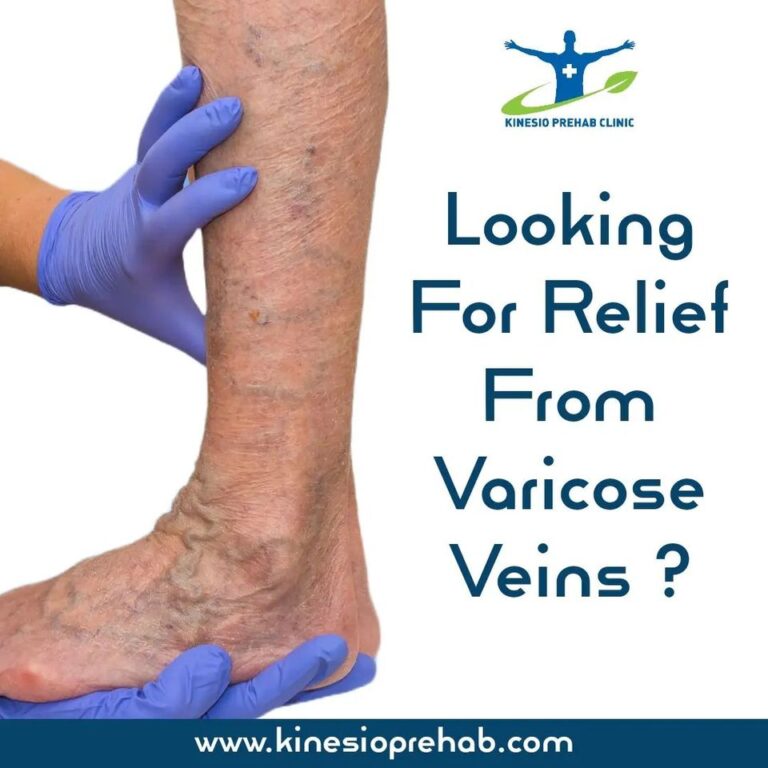 Varicose Veins Therapy Kinesio Prehab InstituteKPI